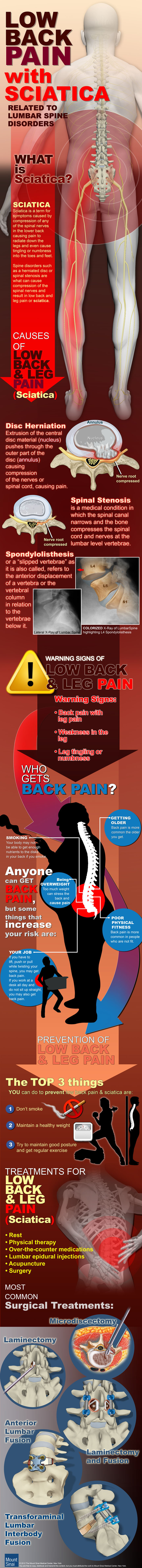 Low Back Pain with Sciatica infographic about back pain, spine, back pain causes, back pain management